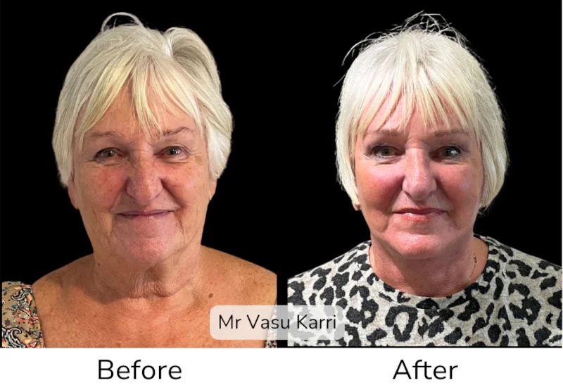 Facelift Patient 4 View 1